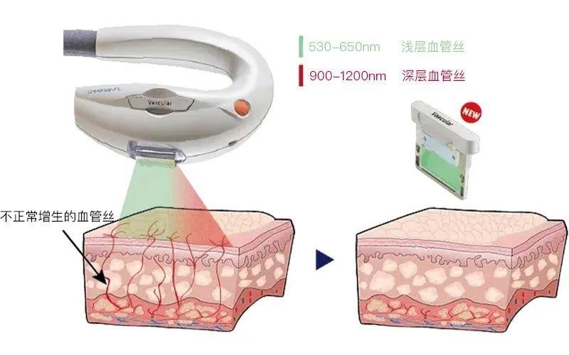 Vascular血管濾光片